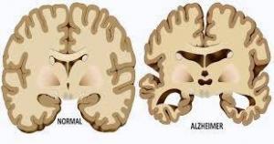 Benfotiamine Nedir, Sağlık Açısından Faydaları Nelerdir?