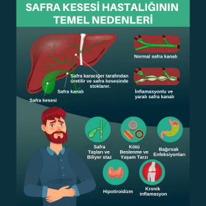 Safra Kesesi Ameliyatlarından Sonra Sindirim Sağlığını İyileştirme Stratejileri