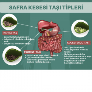 Safra Kesesi Ameliyatlarından Sonra Sindirim Sağlığını İyileştirme Stratejileri