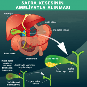 Safra Kesesi Ameliyatlarından Sonra Sindirim Sağlığını İyileştirme Stratejileri