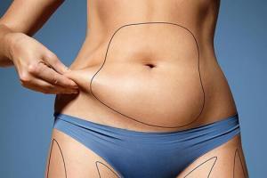 Abdominoplasti (Karın Germe Ameliyatı) Hakkında Bilinmesi Gerekenler
