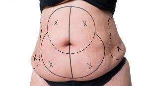 Abdominoplasti (Karın Germe Ameliyatı) Hakkında Bilinmesi Gerekenler