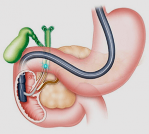 ERCP Nedir, Neden Yapılır?