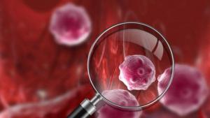 Akut Miyeloid Lösemi: Nedenleri, Belirtileri, Çeşitleri, Tanı ve Tedavi Yöntemleri