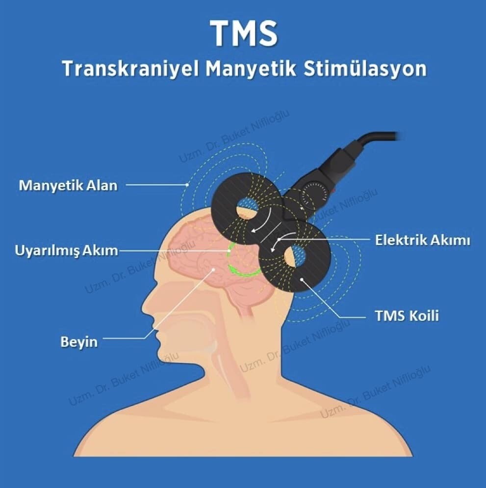 TMS Tedavisi Nedir?