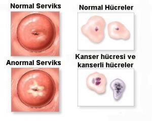Servikal Displazi: Belirtileri, Nedenleri, Tedavisi ve Önlenmesi
