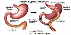 Gastrik Bypass Ameliyatı ile İlgili Bilinmesi Gerekenler