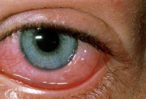 Pseudomonas Enfeksiyonları Nelerdir?