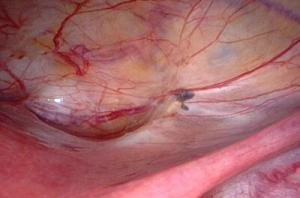 Endometrit (Rahim İçi İltihabı) Nedir?