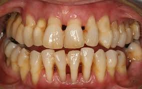 Oral Mikrobiyom Nedir, Nasıl Dengelenir, Genel Sağlıkla Bağlantısı Nasıldır?