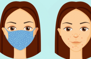Maske Aknesi (Maskne) Nedir, Nasıl Önlenir ve Tedavi Edilir?