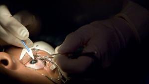 LASIK Göz Ameliyatının Komplikasyonları, Sonuçları ve Riks Faktörleri