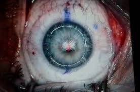 LASIK'ın Tarihi ve Geçirdiği Aşamalar