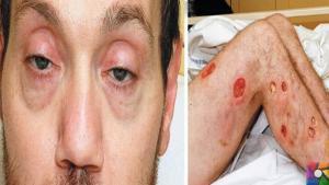 Botulizm Nedir?