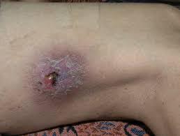 Melioidoz (Melioidosis) Nedir?