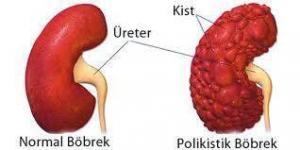 Edinilmiş Kistik Böbrek Hastalığı Hakkında Bilinmesi Gerekenler
