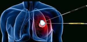 Akciğer Kanseri Cerrahisi (Endo-Bronşiyal) Alanındaki Gelişmeler
