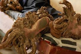 Ağaç Adam Hastalığı  (Epidermodysplasia verruciformis) Nedir?