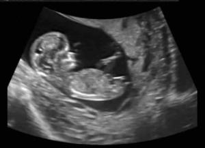 Üçüncü Trimesterde Ultrason Görüntülemenin Faydaları