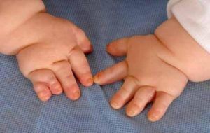 Aarskog Sendromu Nasıl Bir Hastalıktır?