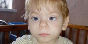 Fetal Alkol Sendromu