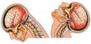 Ensefalit Nedir?