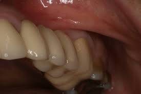 Dentoalveolar Cerrahide (Diş Cerrahisi) Krestal Anestezi