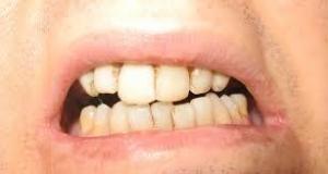 Dentoalveolar Cerrahide (Diş Cerrahisi) Krestal Anestezi