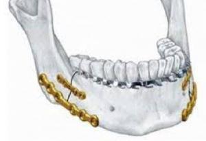 Gömülü Diş Ameliyatı Sonrası Kemik Komplikasyonları