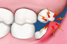 Gömülü Diş Ameliyatından Sonra Oluşan Genel Komplikasyonlar
