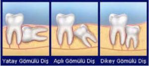 Gömülü Diş Cerrahisinin Çevre Dişlere Etkisi