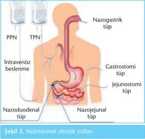 Enteral Beslenme Mideye Zarar Verir mi?