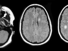 Multipl Sklerozda (MS) Serotonin Düzeyleri