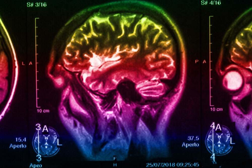 Epileptik ve Parkinson Hastalarında Serotonin Seviyeleri