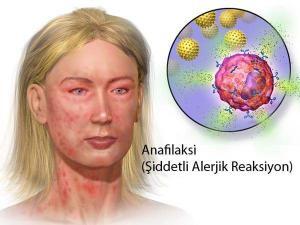 Kuruyemiş Alerjileri, Nedenleri, Teşhisi ve Tedavisi
