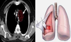 Malign Mezotelyoma (MM) Nedir?