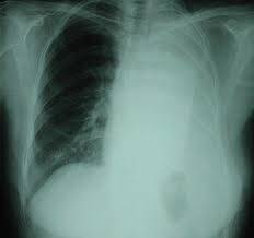 Malign Mezotelyoma (MM) Nedir?