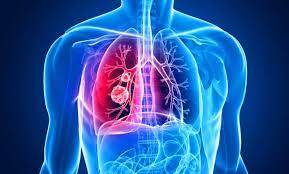 Malign Mezotelyoma (MM) Nedir?