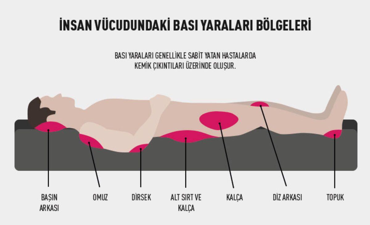 Basınç Ülserleri (Yatak Yaraları) Hakkında Bilinmesi Gerekenler