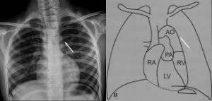 Büyük Arterlerin Transpozisyonunda (TGA) Cerrahi Yönetim ve Prosedürler
