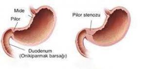 Yenidoğan Bebeklerde Duodenal Atrezi, Pilor Stenozu ve Biliyer Atrezi