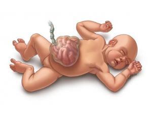 Doğumsal Orta Bağırsak Bozuklukları (Midgut)