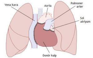 Büyük Arterlerin Transpozisyonu (TGA) Nedir?