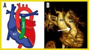 Büyük Arterlerin Transpozisyonu (TGA) Nedir?
