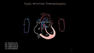 Büyük Arterlerin Transpozisyonu (TGA) Nedir?