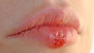 Bebeklerde Herpes Simpleks, Suçiçeği ve Zoster Virüsünün Etkileri