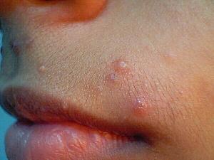 Molluscum Contagiosum: Tanı ve Tedavi Yöntemleri Nelerdir?