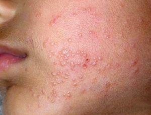 Molluscum Contagiosum: Tanı ve Tedavi Yöntemleri Nelerdir?