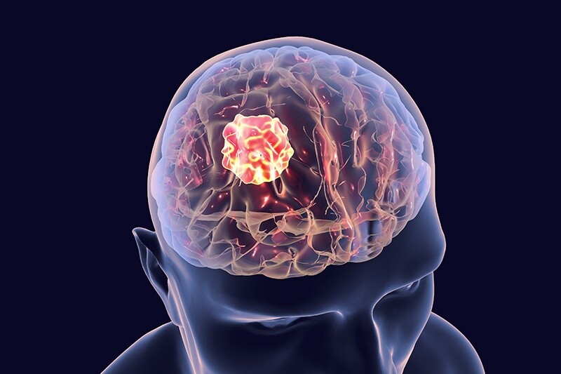 Beynin Glioblastomu Nedir?