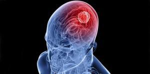 Oligodendroglioma ve Teşhis, Tedavi Yöntemleri Nelerdir?